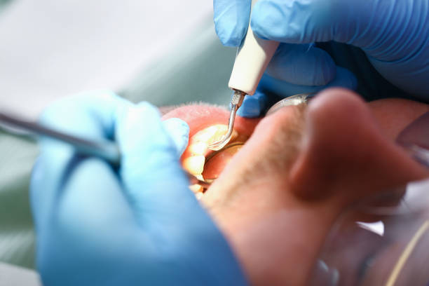 Best Emergency Tooth Extraction in Mauriceville, TX